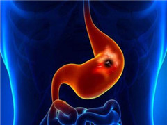 胃癌的检查以及怎样预防胃癌？