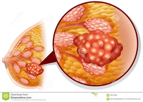 乳腺癌是什么原因导致的？
