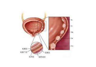 膀胱癌早期的存活率