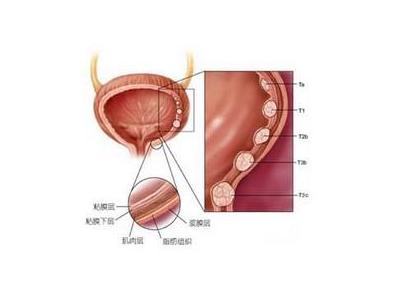 预防膀胱癌的方法