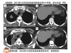 克唑替尼的适用范围被扩大