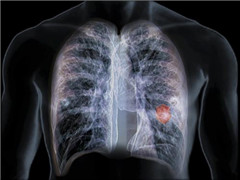 肺癌会传染吗？