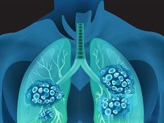 肺癌的可怕之处在哪里？