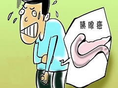 奥拉帕尼治疗胰腺癌