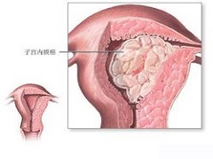 PD-1联合乐伐替尼治疗子宫内膜癌