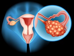 奥拉帕尼治疗晚期卵巢癌效果真的好吗？
