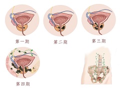 如何服用阿比特龙？