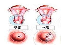 如何判断宫颈癌的早晚期