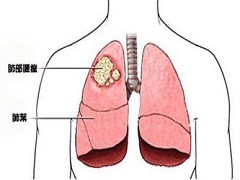 使用派姆单抗治疗时发生肝毒性怎么办才好？