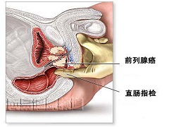 阿比特龙与奥拉帕尼联合可治疗前列腺癌！