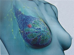 帕妥珠单抗是为赫赛汀危机研发的乳腺癌药物