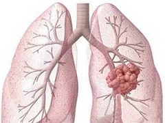 患者服用克唑替尼期间可能会患上“飞蚊症”。
