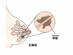 奥拉帕尼治疗乳腺癌的效果如何？