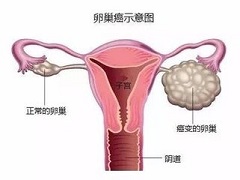 奥拉帕尼单药与联合用药的治疗效果有何不同？