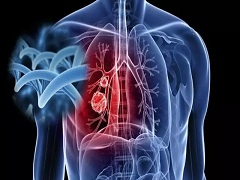 色瑞替尼对ALK阳性的非小细胞肺癌的治疗