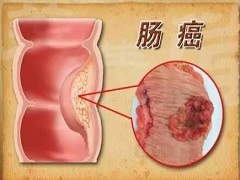 瑞格菲尼治疗肠癌应如何调整计量？