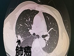 阿法替尼联合贝伐单抗可以诱导T790M阴转阳？