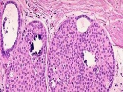 乳腺癌患者可以选择印度帕博西尼
