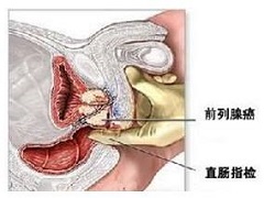 使用阿比特龙患者为何还需维持趋势治疗