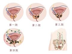 阿比特龙是强生出品的款重磅药物