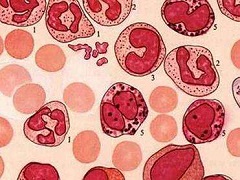 真性红细胞增多症使用芦可替尼