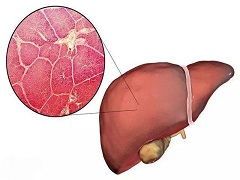 奥贝胆酸关于能否治疗NASH所进行的实验研究