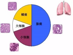 艾乐替尼能够大概率缓解肺癌症状