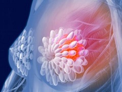 帕妥珠单抗缩小肿瘤的乳腺癌患者术前有巨大潜力