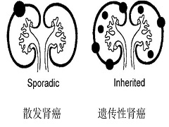 舒尼替尼可用于肾癌患者的辅助治疗