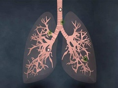 曲美替尼和达拉非尼联合可有效控制肺癌