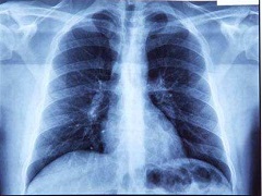 发生脑转移肺癌患者的可使用布加替尼