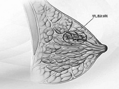 来那替尼仅对HER2阳性乳腺癌的患者明显