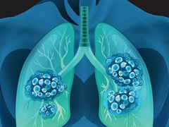 阿法替尼可以延长肺癌患者的生存期。
