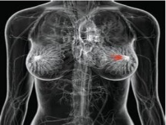 帕妥珠单抗是HER2阳性乳腺癌的常用药之一
