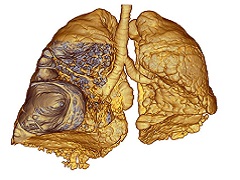 发生进展的肺癌患者可使用布加替尼治疗