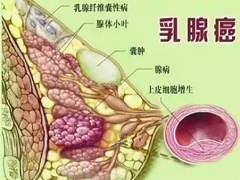 辅助性帕妥珠单抗应该用于HER2阳性乳腺癌患者吗