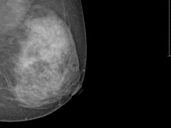 PARP抑制剂尼拉帕尼治疗三阴乳腺癌的疗效如何