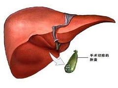 奥贝胆酸导致PBC患者出现黄疸