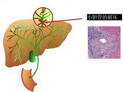 奥贝胆酸在治疗过程中出现肝损伤怎么办