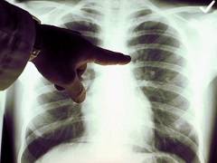 色瑞替尼能够充分抑制晚期肺癌患者的病情