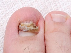 曲美替尼联合达拉菲尼能够发挥成倍的药效
