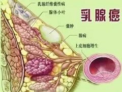 帕妥珠单抗用于之前未接受过HER2治疗的患者