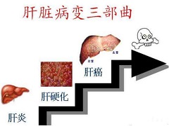 以下肝癌患者不能使用索拉非尼