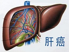 为何使用索拉非尼会有静脉曲张出血现象