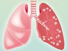 阿法替尼治疗亚洲肺癌患者疗效更加显著。