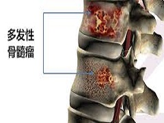 达雷木单抗能够治疗不符合干细胞移植资格的患者