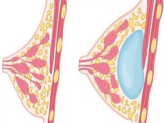 辅助剂帕妥珠单抗(Pertuzumab)治疗早期HER2阳性乳腺癌
