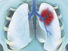 PARP抑制剂尼拉帕尼可能能用于治疗小细胞肺癌
