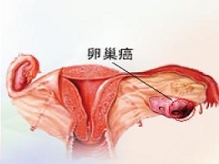 FDA批准Zejula尼拉帕尼作为卵巢癌的持续治疗