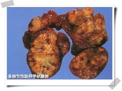 凡德他尼能否显著提高患者的生存率